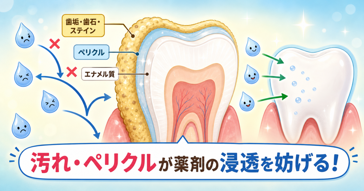 ■歯垢・歯石・ペリクルがホワイトニング薬剤の浸透を妨げる仕組み