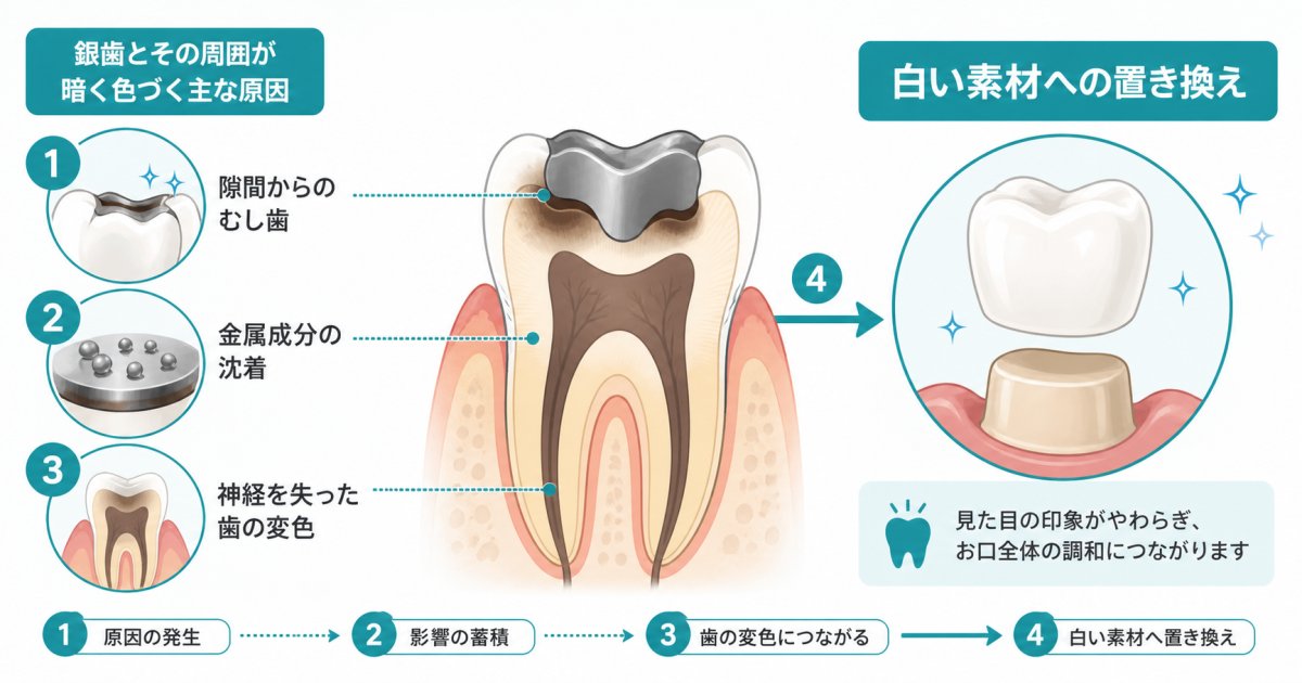 銀歯の周りの歯が黒ずむ原因は？むし歯との見分け方と治療法