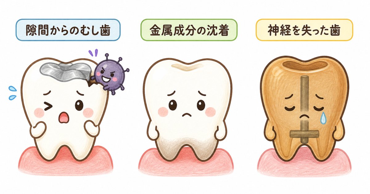 銀歯の周りの歯が黒ずむ3大原因と変色のメカニズム