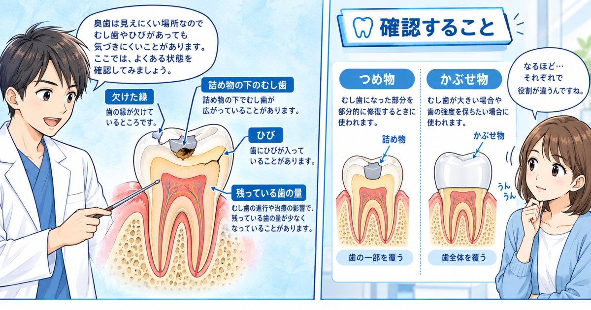 欠けた銀歯は、詰め物の交換だけで済む？